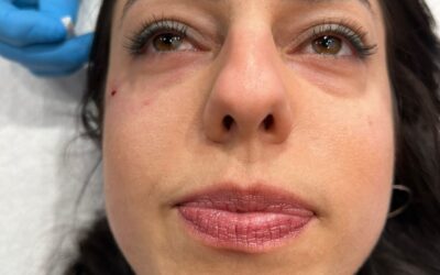 Eliminar las ojeras – nuevas tendencias