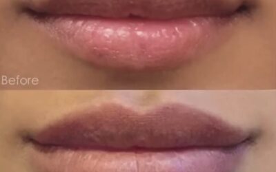 Inyecciones labiales con ácido hialurónico Explicación breve de las complicaciones